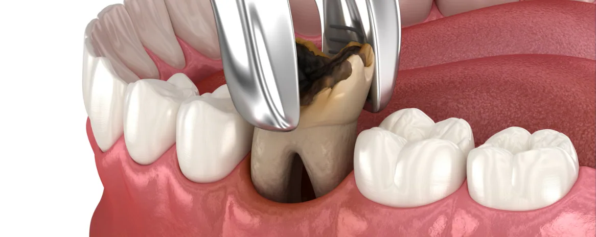 3D illustration of dental forceps removing a decayed molar