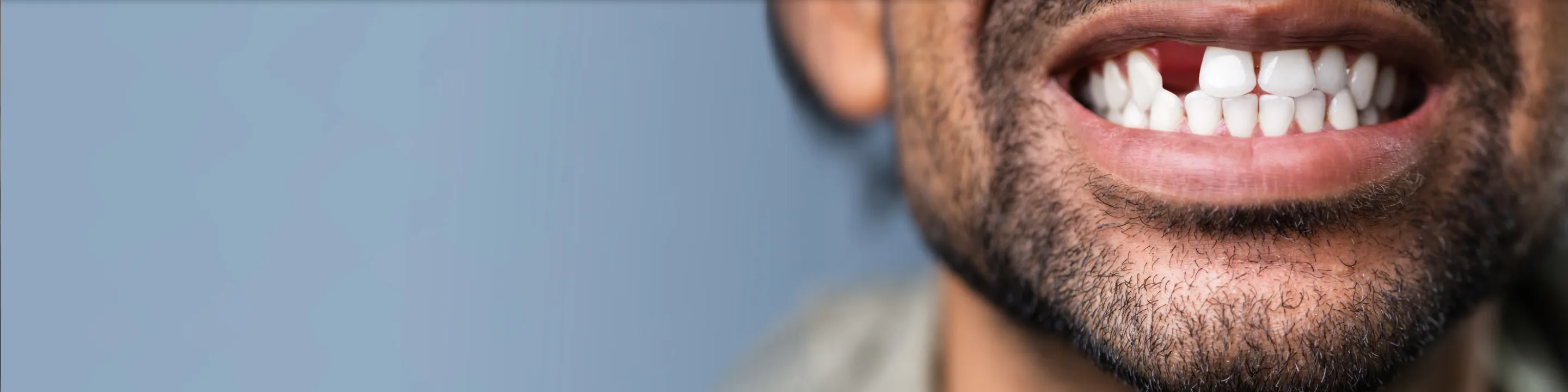 Close-up of a bearded man smiling with a missing front tooth