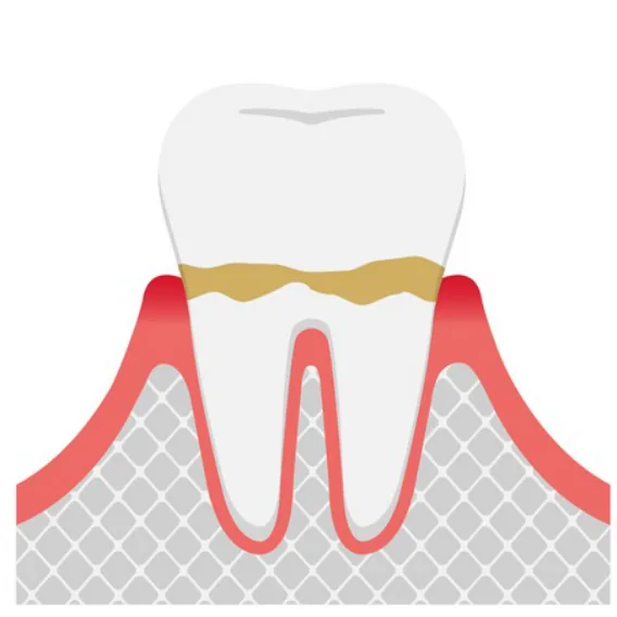 Illustration of a tooth with plaque along an inflamed gumline