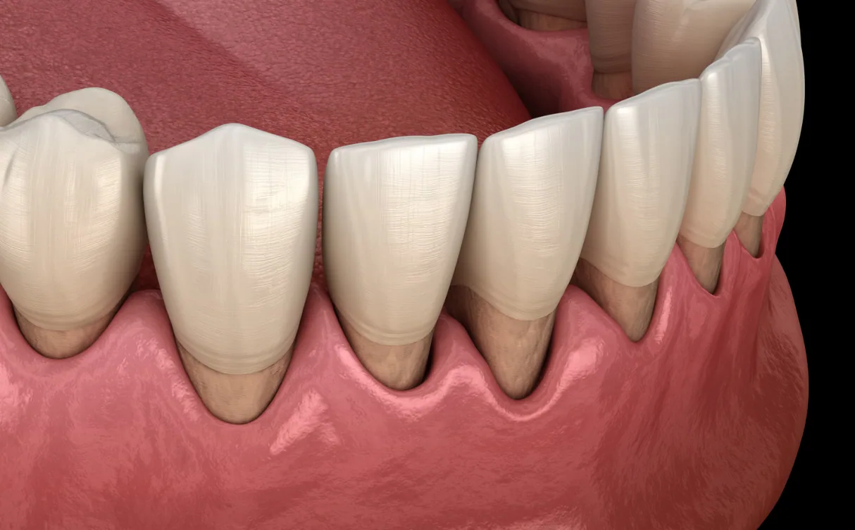 Close-up illustration of lower teeth with receding gums exposing the tooth roots