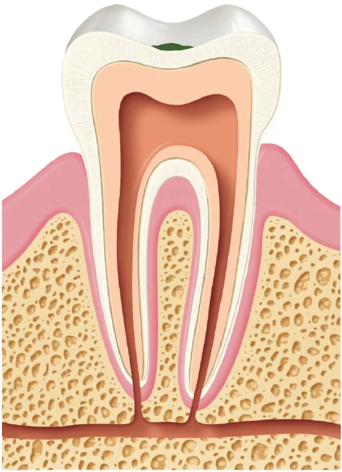 Tooth cross-section with a small white spot of demineralised enamel