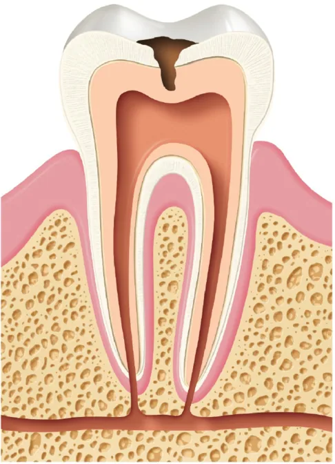 Tooth cross-section with decay reaching the dentin