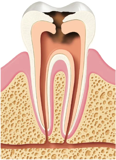 Tooth cross-section with decay reaching the pulp