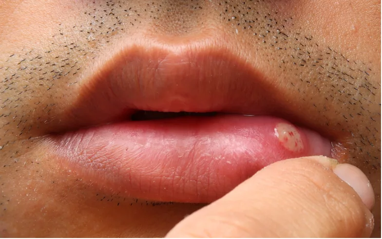 A mouth ulcer on the inside of the lower lip