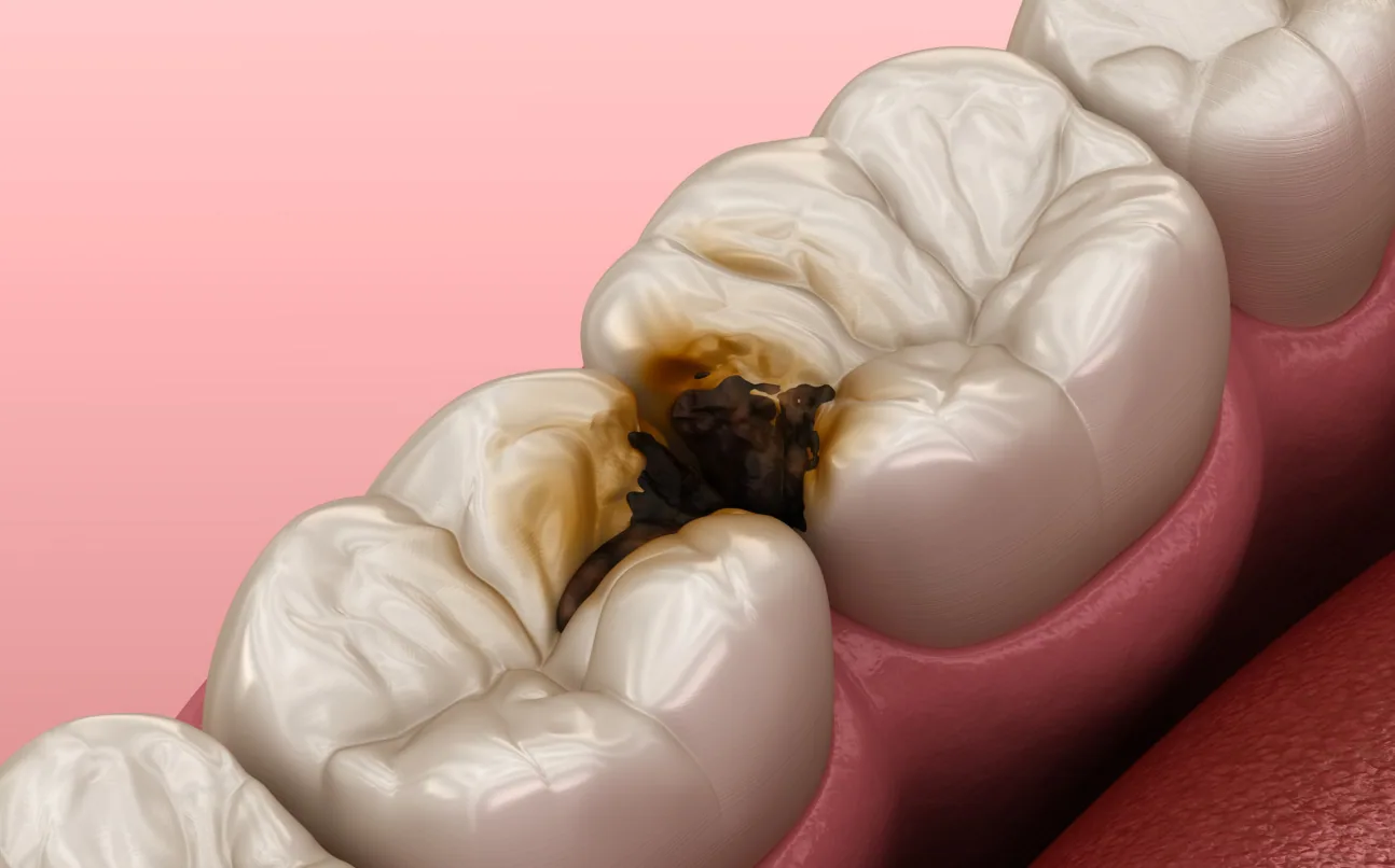 Illustration of molar teeth with dark decay