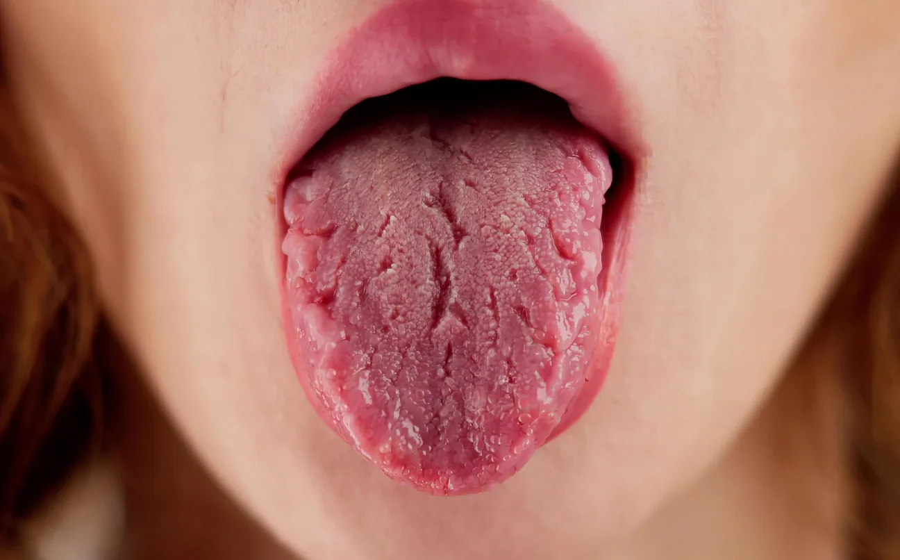 A woman sticking out a dry, cracked tongue