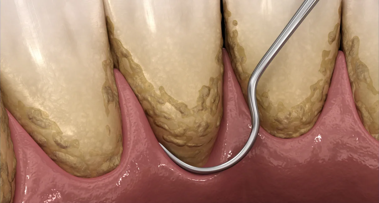 Illustration of a dental instrument cleaning tartar below the gumline