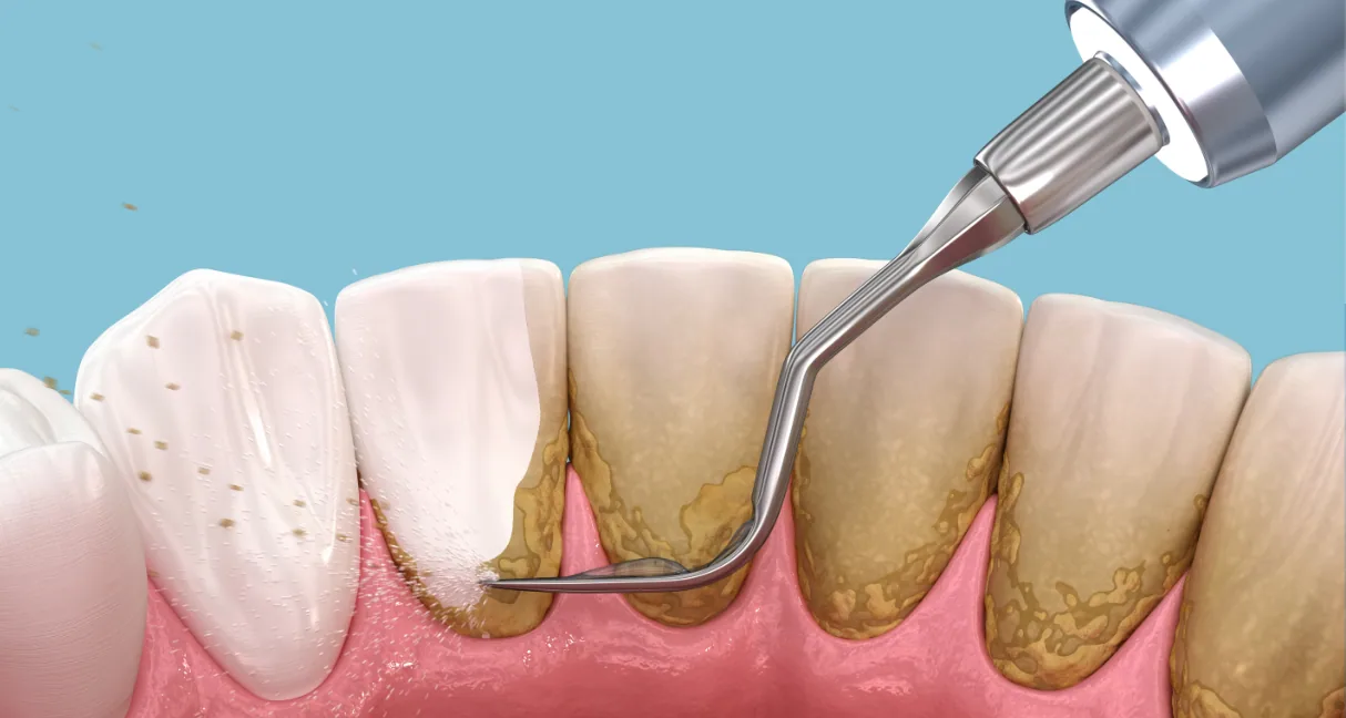 Illustration of an ultrasonic scaler removing tartar from the teeth at the gumline